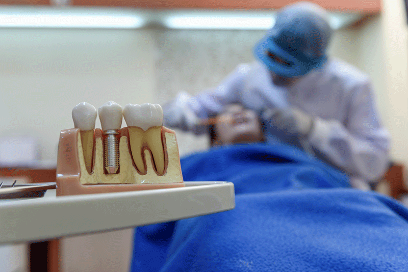 Capped dental implant model on desk in dentists’ office with copy space. Focusing shoot on dental implant model.