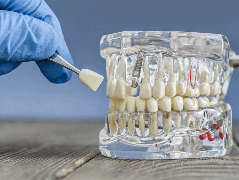 Explore tooth replacement options, including dental implants, and restore your smile with expert care and personalized solutions.